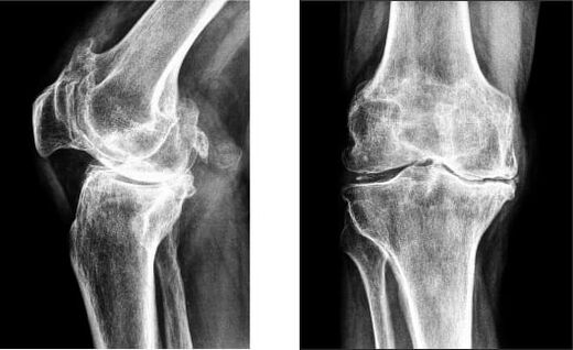 Radiografia de gonartroză a genunchiului