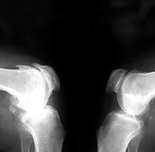 Osteoartrita la o radiografie