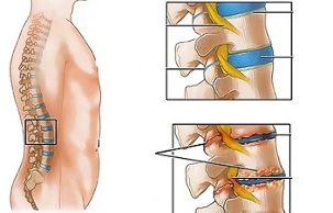 Cauzele osteocondrozei coloanei lombare