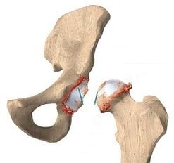 Cauzele osteoartritei articulației șoldului