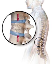 Osteoporoza provoacă dureri de spate în zona lombară