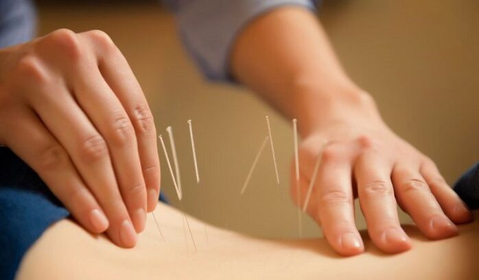 Acupunctura utilizată pentru tratarea durerilor de spate